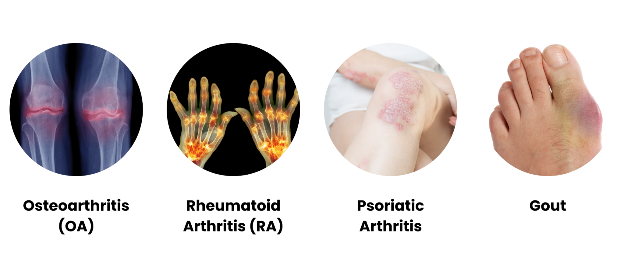 Understanding Arthritis Symptoms Types And Care All Heart Homecare